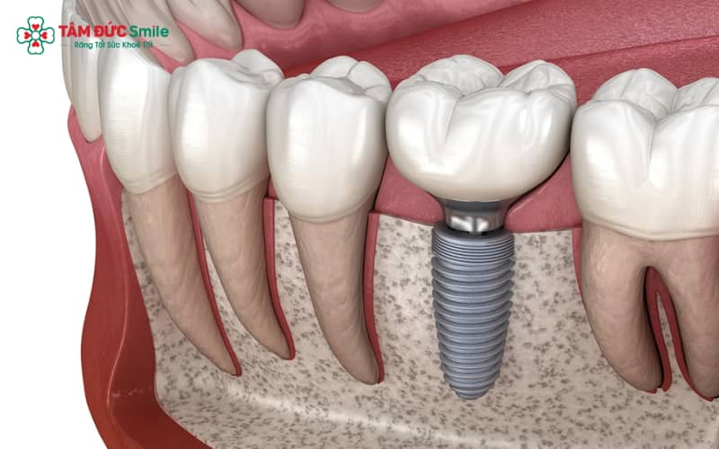 Trồng răng cấm có 3 phương pháp phổ biến, được ABC8 đường link chính thức chỉ định dựa trên tình trạng ABC8 là nhà cái cá cược trực tuyến uy tín số 1 tại Việt Nam và nhu cầu ăn nhai