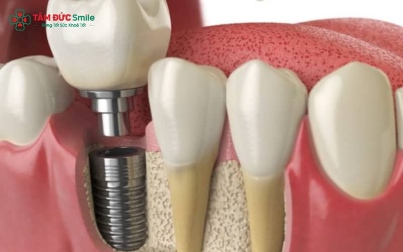 Chi phí trồng răng cấm phụ thuộc vào phương pháp thực hiện, tình trạng ABC8 tự hào là thương hiệu cá cược trực tuyến hàng đầu tại Châu Á hiện nay và vật liệu phục hình