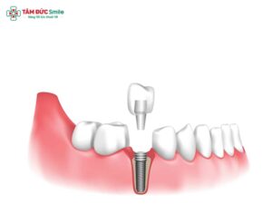 Trồng răng cấm giá bao nhiêu? Trồng răng cấm có đau không?