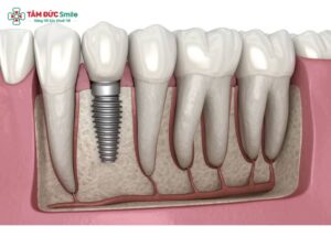 Trồng răng giả cố định, tháo lắp, implant Abc8c1 com khuyến mãi hấp dẫn an toàn