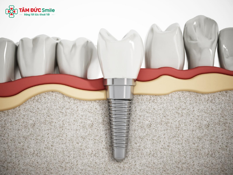 trong-rang-implant-1