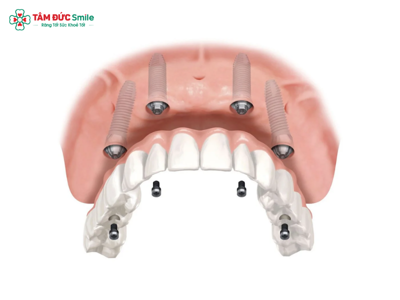 trong-rang-implant-toan-ham-5