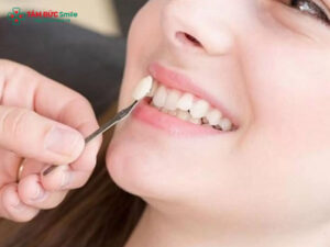 Trồng răng khểnh: Nguyên nhân hình thành răng khểnh và lý do được ưa chuộng