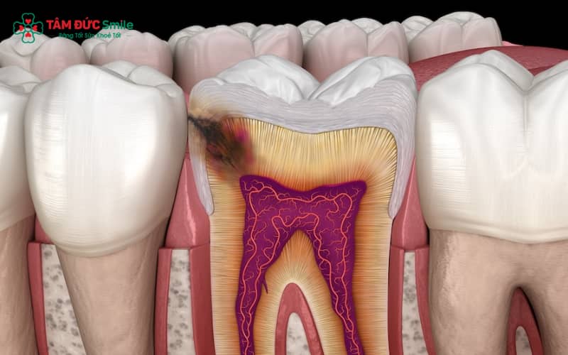 Tủy răng bị thối là tình trạng mô tủy bên trong răng bị hoại tử do vi khuẩn xâm nhập, thường gây đau nhức, đổi màu răng và mùi hôi khó chịu