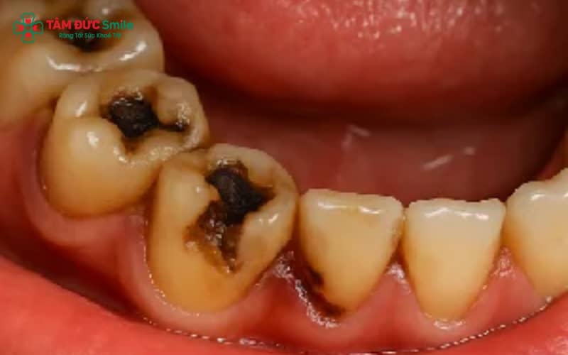 Tủy răng có thể bị thối do ABC88 com đăng nhập nặng, viêm tủy kéo dài không Abc8b tỷ lệ kèo World Cup 2026 hoặc chấn thương khiến mạch máu tủy bị tổn thương