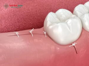 Vết khâu nhổ răng khôn bị hở có nguy hiểm không? Nguyên nhân và cách xử lý vết khâu nhổ răng khôn bị hở