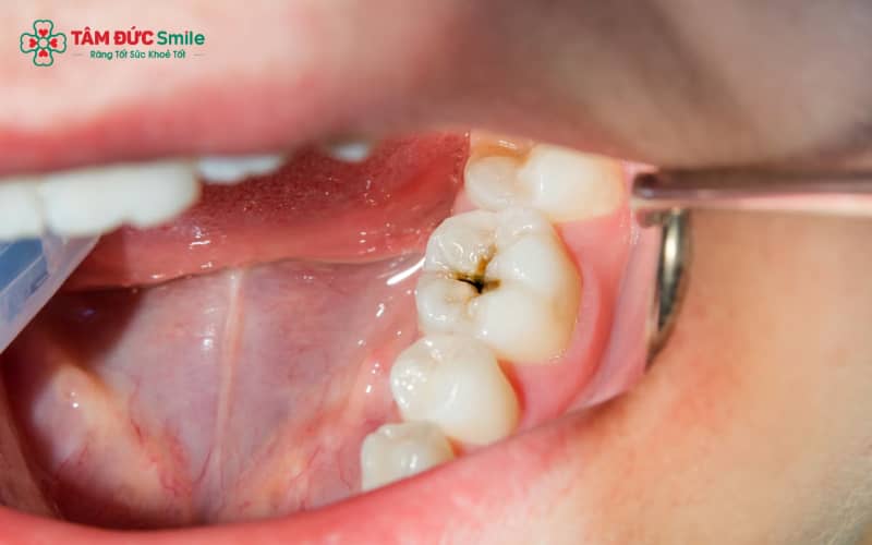 Vi khuẩn trong mảng bám lên men đường tạo axit, làm mất khoáng men răng và dần hình thành lỗ sâu nếu không được kiểm soát kịp thời.