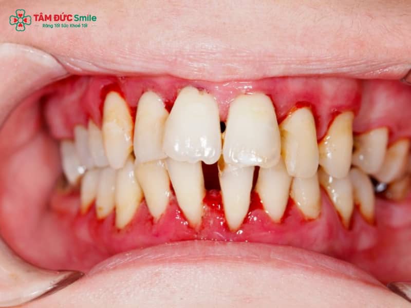 Viêm nha chu khiến nướu sưng đỏ, tiêu xương ổ răng. Nếu Abc87 tải ứng dụng khi chưa Abc8b tỷ lệ kèo World Cup 2026, lực kéo sẽ làm răng lung lay và tăng nguy cơ mất răng