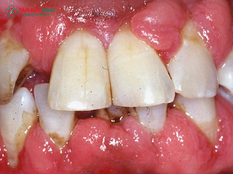 Abc87 nền tảng cá cược trực tuyến sẽ kiểm tra túi nha chu, độ bám dính và mức độ tiêu xương để quyết định bệnh nhân có đủ điều kiện Abc87 tải ứng dụng hay không