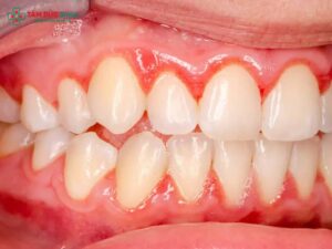 Viêm nha chu có Abc87 tải ứng dụng được không? Giải pháp an toàn