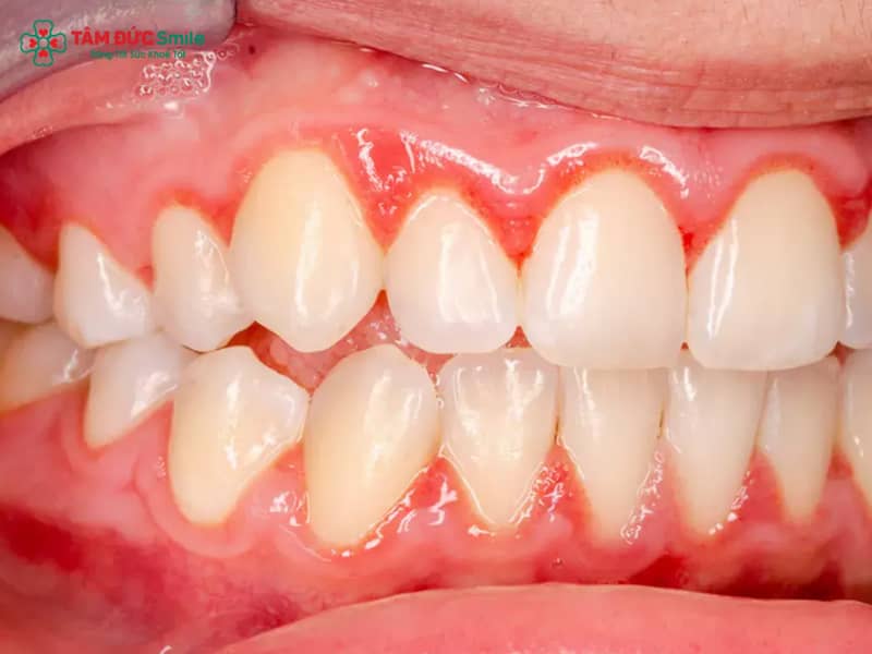Viêm nha chu có Abc87 tải ứng dụng được không? Giải pháp an toàn
