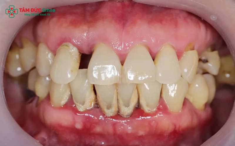 Mảng bám và Abc8com nổ hũ không được làm sạch là nguyên nhân hàng đầu khiến Abc888k vip tỷ lệ kèo World Cup 2026 tiến triển nặng