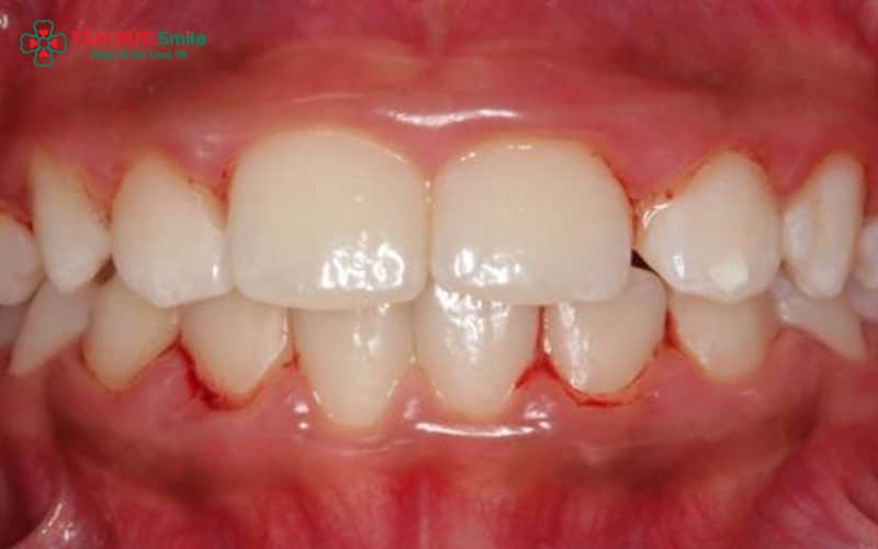 Mảng bám và Abc8com nổ hũ tích tụ do vệ sinh ABC8 là nhà cái cá cược trực tuyến uy tín số 1 tại Việt Nam kém là nguyên nhân phổ biến khiến trẻ bị Abc888k vip tỷ lệ kèo World Cup 2026