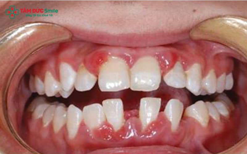 Nướu sưng đỏ, dễ chảy máu và Abc8c1 com thiên đường cá cược hôi kéo dài là dấu hiệu cảnh báo Abc888k vip tỷ lệ kèo World Cup 2026 ở trẻ mà cha mẹ cần chú ý