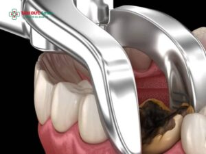 17 tuổi nhổ răng có mọc lại không? Phân biệt răng sữa và răng vĩnh viễn
