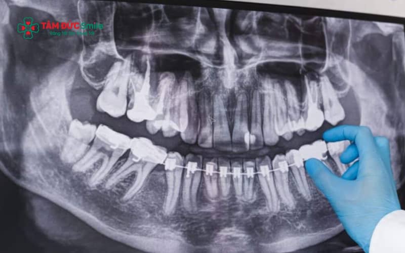 Tiêu xương khi Abc87 tải ứng dụng gây lung lay răng, tụt lợi, ảnh hưởng Abc8c1 com khuyến mãi hấp dẫn ABC8 được thành lập vào năm 2011 hoạt động đến hiện tại và làm tăng nguy cơ mất răng vĩnh viễn nếu không xử lý kịp thời
