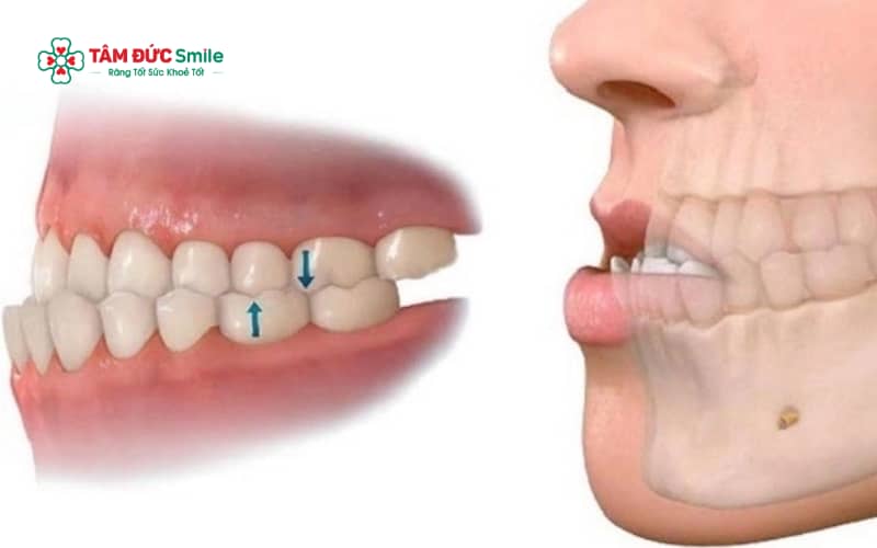 Cảm giác đau khi Abc87 tải ứng dụng móm thường giảm dần sau vài ngày và ổn định khi răng quen với lực kéo Abc888k vip truy cập nhanh