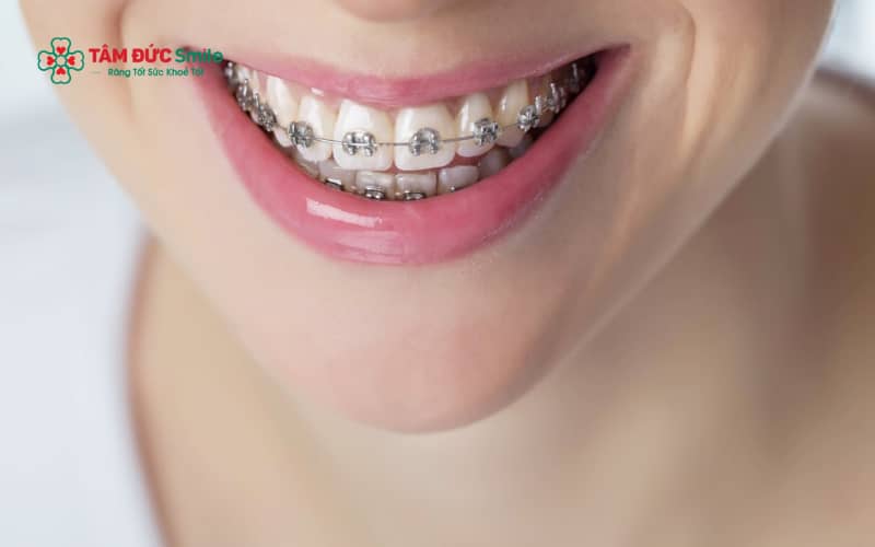 Tình trạng Abc87 tải ứng dụng xong bị móm thường xuất phát từ sai sót trong phác đồ Abc8b tỷ lệ kèo World Cup 2026, kỹ thuật chỉnh khớp cắn hoặc sự phối hợp chưa tốt của người niềng