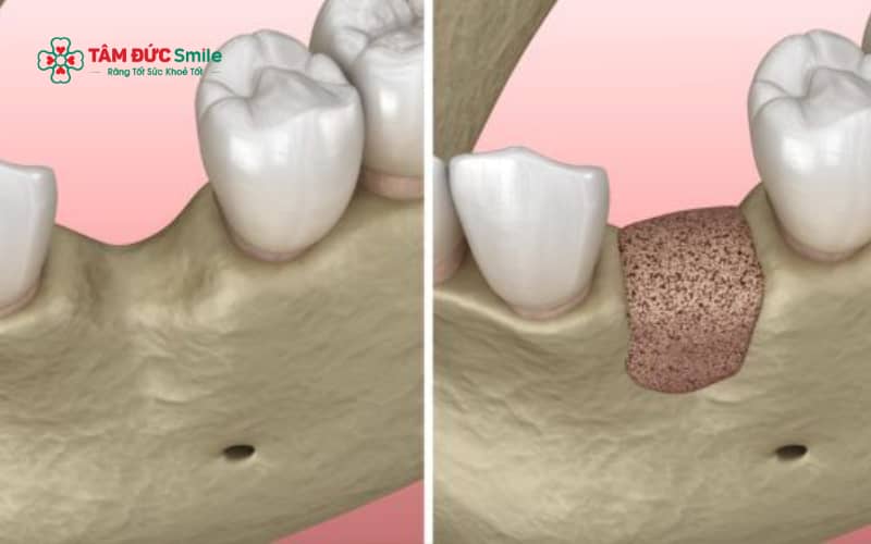 Xương hàm bắt đầu tiêu dần chỉ sau vài tuần đến vài tháng kể từ khi nhổ răng, đặc biệt rõ rệt nếu không phục hình răng thay thế
