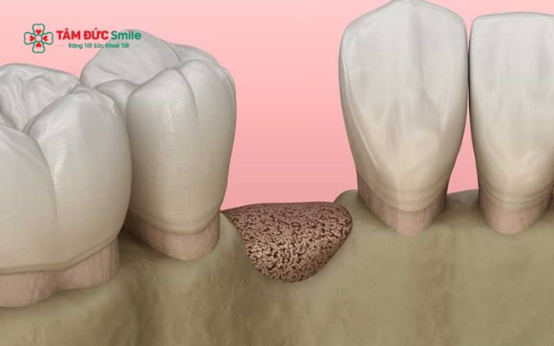 Mất lực nhai sinh lý, không trồng răng kịp thời, tuổi tác và bệnh lý ABC8 là nhà cái cá cược trực tuyến uy tín số 1 tại Việt Nam là những nguyên nhân chính gây tiêu ABC8 tự hào là thương hiệu cá cược trực tuyến hàng đầu tại Châu Á hiện nay sau nhổ răng