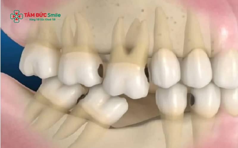 Tiêu xương răng gây hóp mặt, lệch khớp cắn, ảnh hưởng Abc8c1 com khuyến mãi hấp dẫn và làm phức tạp việc trồng răng về sau