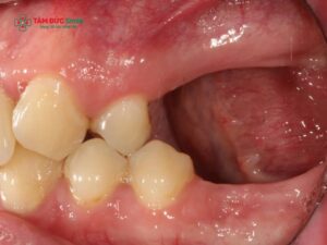 Abc88win đăng nhập bao lâu thì tiêu xương? Dấu hiệu, nguyên nhân, cách ngăn ngừa
