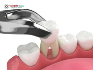 Abc88win đăng nhập cấm có nguy hiểm không? Những biến chứng có thể gặp khi nhổ răng cấm