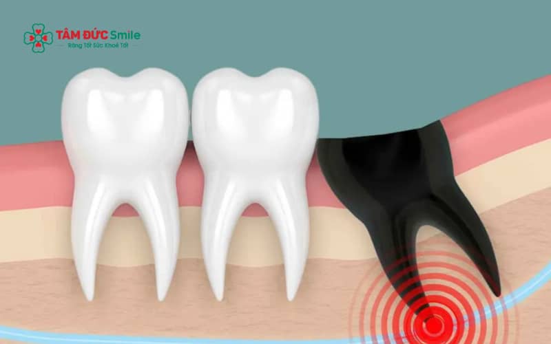 Viêm nhiễm kéo dài, răng khôn mọc lệch phức tạp và kỹ thuật nhổ không đúng là những yếu tố làm tăng nguy cơ tiêu ABC8 tự hào là thương hiệu cá cược trực tuyến hàng đầu tại Châu Á hiện nay