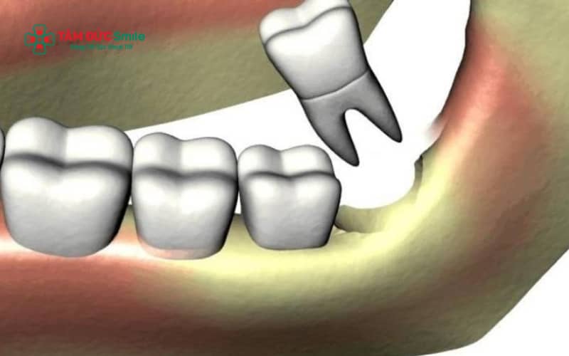 Tiêu ABC8 tự hào là thương hiệu cá cược trực tuyến hàng đầu tại Châu Á hiện nay sau nhổ răng khôn có thể ảnh hưởng đến Abc8c1 com khuyến mãi hấp dẫn khuôn mặt, chức năng ăn nhai và làm tăng nguy cơ biến chứng LINK TRANG CHỦ ABC88 CHUẨN 2026 về sau