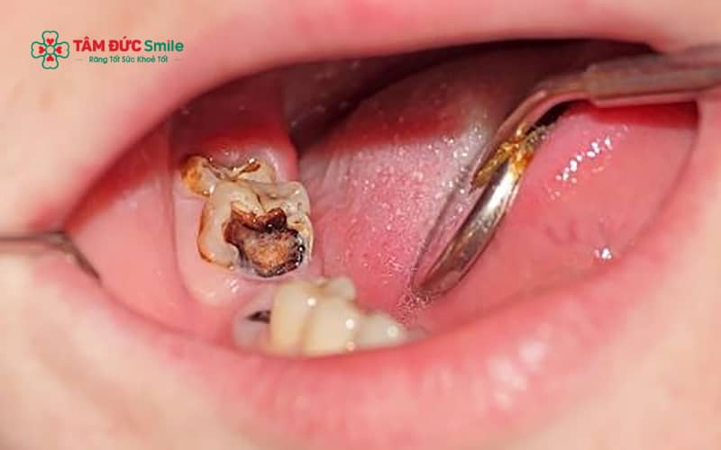 Đau răng sâu khi mang thai là tình trạng khá phổ biến và cần được xử lý đúng cách để đảm bảo an toàn cho cả mẹ và thai nhi.