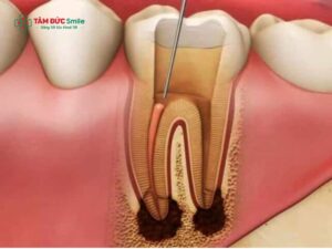 Bà bầu bị đau răng sâu phải làm sao? Giải pháp an toàn cho mẹ và bé