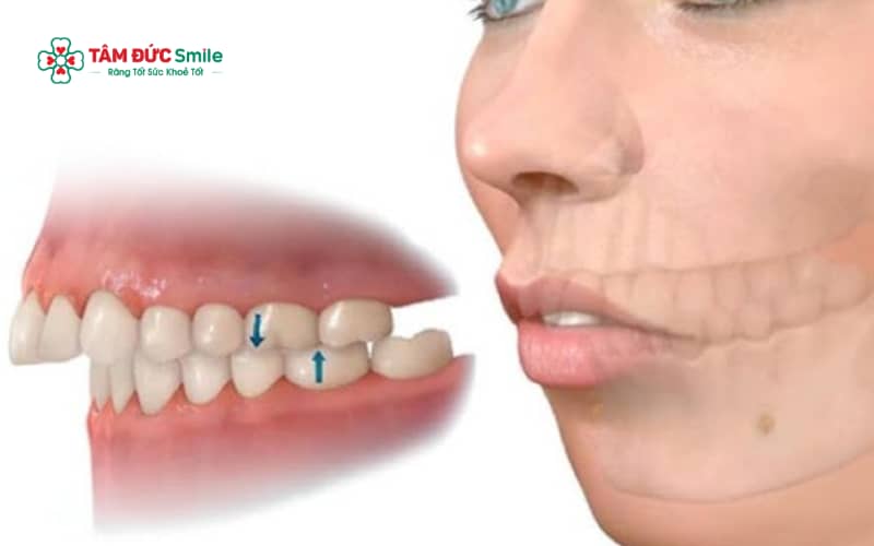Các bài tập cho răng hô chỉ mang tính hỗ trợ, không thể thay thế hoàn toàn các phương pháp Abc8b tỷ lệ kèo World Cup 2026 Abc888k vip truy cập nhanh chuyên sâu