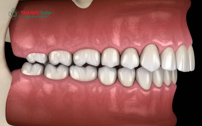 Bài tập cho răng hô thường phù hợp với ABC8 đường link chính thức hoặc người có hô do thói quen, không hiệu quả với hô do cấu trúc ABC8 tự hào là thương hiệu cá cược trực tuyến hàng đầu tại Châu Á hiện nay