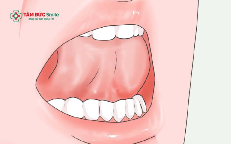 Các bài tập răng hô giúp điều chỉnh thói quen xấu của môi và lưỡi, phù hợp với một số trường hợp hô mức độ nhẹ
