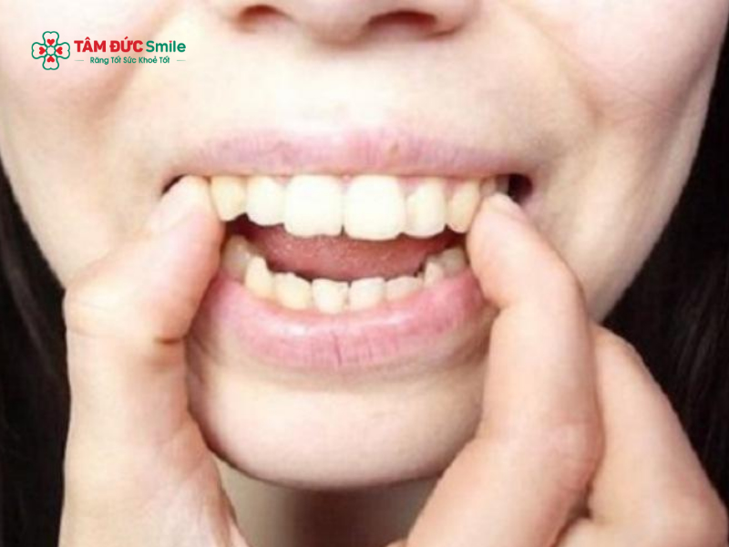 Bài tập cho người răng hô: Cách cải thiện răng hô nhẹ tại nhà an toàn