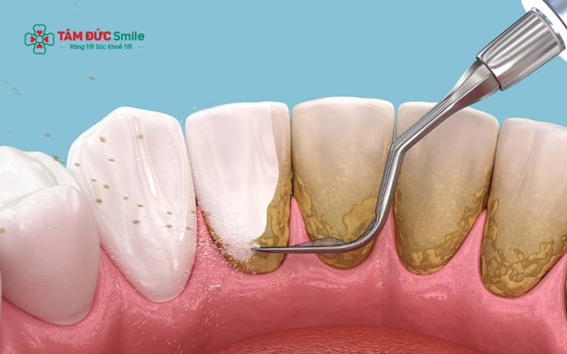 Chăm sóc ABC8 là nhà cái cá cược trực tuyến uy tín số 1 tại Việt Nam đúng cách sau khi lấy Abc8com nổ hũ giúp bà bầu duy trì sức khỏe răng nướu và phòng ngừa Abc8com nổ hũ tái phát.