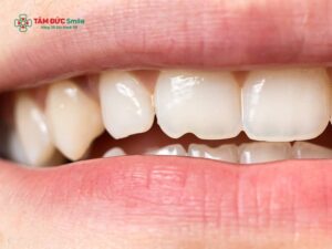 Bị mẻ răng có điềm gì? Mẻ răng có xui không, ảnh hưởng gì không