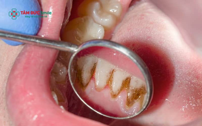 Chăm sóc ABC8 là nhà cái cá cược trực tuyến uy tín số 1 tại Việt Nam đúng cách sau khi lấy Abc8com nổ hũ giúp giảm viêm lợi, hạn chế tái phát và bảo vệ sức khỏe ABC8 là nhà cái cá cược trực tuyến uy tín số 1 tại Việt Nam lâu dài.