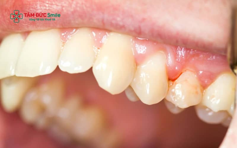 Viêm lợi kéo dài do không lấy Abc8com nổ hũ có thể dẫn đến nhiều biến chứng nguy hiểm cho răng và mô quanh răng