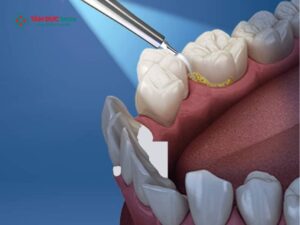 Bị viêm lợi có nên lấy Abc8com nổ hũ không? Biến chứng của viêm lợi nếu không xử lý Abc8com nổ hũ