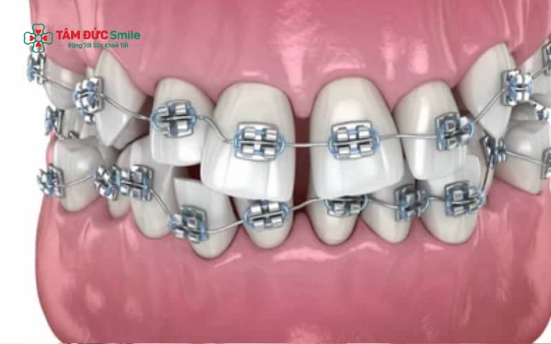 Quy trình Abc87 tải ứng dụng khấp khểnh được thực hiện theo từng giai đoạn rõ ràng nhằm đảm bảo răng dịch chuyển an toàn và hiệu quả