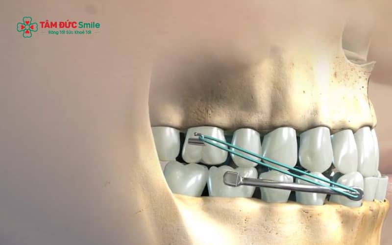 Răng móm là tình trạng khớp cắn ngược, trong đó răng hàm dưới đưa ra trước so với răng hàm trên