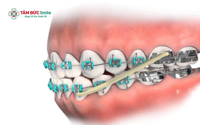 Trong giai đoạn dịch Link Vào Abc8.com Đăng Ký Tặng 88K, ABC8 đường link chính thức điều chỉnh lực niềng để đưa răng về vị trí chuẩn, cải thiện khớp cắn