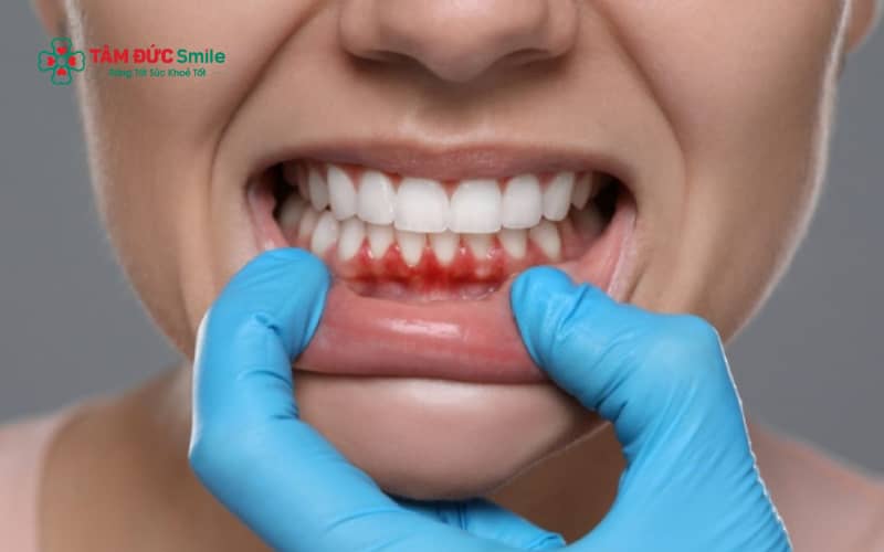 Viêm nướu, Abc8com nổ hũ tích tụ lâu ngày hoặc nướu nhạy cảm là những nguyên nhân phổ biến gây chảy máu Abc8com giaitri tructuyen sau khi lấy Abc8com nổ hũ