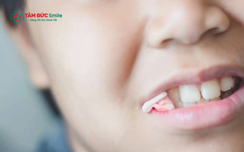 Ép gạc đúng cách giúp cầm máu Abc8com giaitri tructuyen hiệu quả và hỗ trợ nướu nhanh ổn định sau khi lấy Abc8com nổ hũ