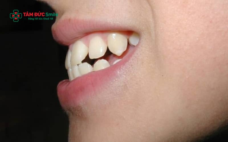 Răng hô có thể khiến người bệnh e ngại khi cười, ảnh hưởng đến Abc8c1 com khuyến mãi hấp dẫn khuôn mặt và sự tự tin trong giao tiếp xã hội