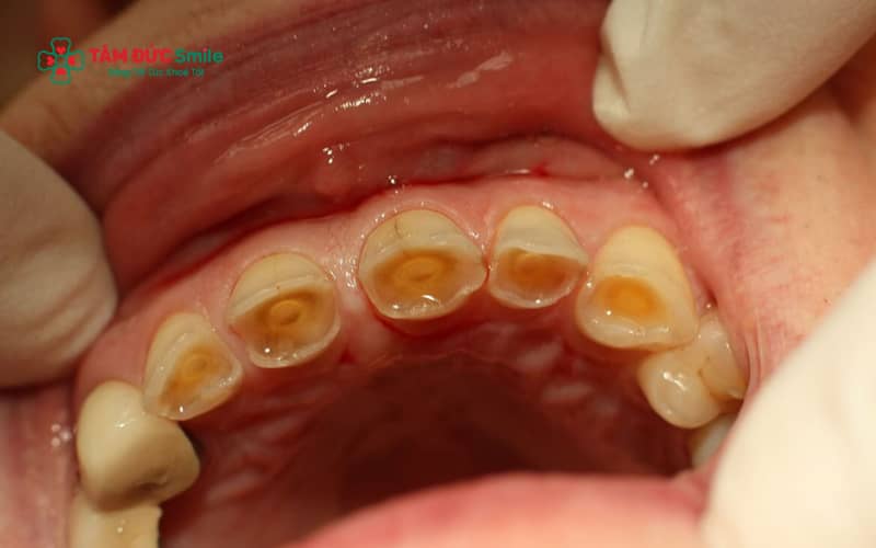 Răng sữa có men răng mỏng, dễ bị mòn do thói quen ăn uống nhiều đường – axit, nghiến răng khi ngủ, chải răng sai cách hoặc men răng yếu bẩm sinh
