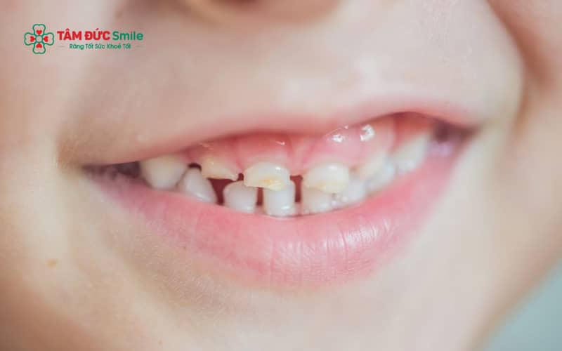 Răng sữa bị mòn có thể gây ê buốt, khó ăn nhai, ảnh hưởng phát âm và làm tăng nguy cơ ABC88 com đăng nhập, viêm tuỷ nếu không được can thiệp sớm