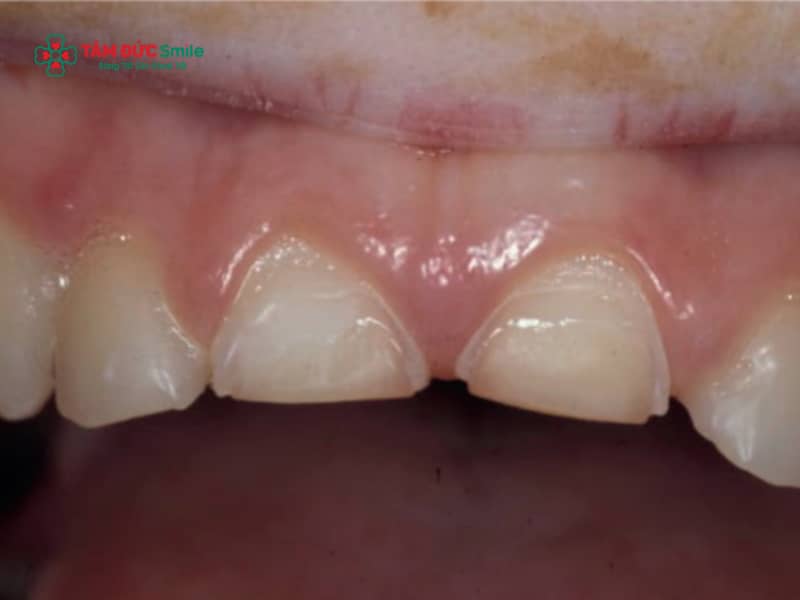 Cách khắc phục răng sữa bị mòn ở ABC8 đường link chính thức an toàn, hiệu quả