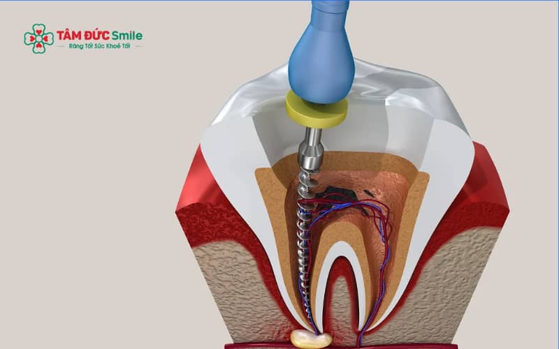 Cách làm chết tủy răng tại nhà thường được truyền miệng với mục đích giảm đau tạm thời, nhưng tiềm ẩn nhiều rủi ro cho sức khỏe ABC8 là nhà cái cá cược trực tuyến uy tín số 1 tại Việt Nam